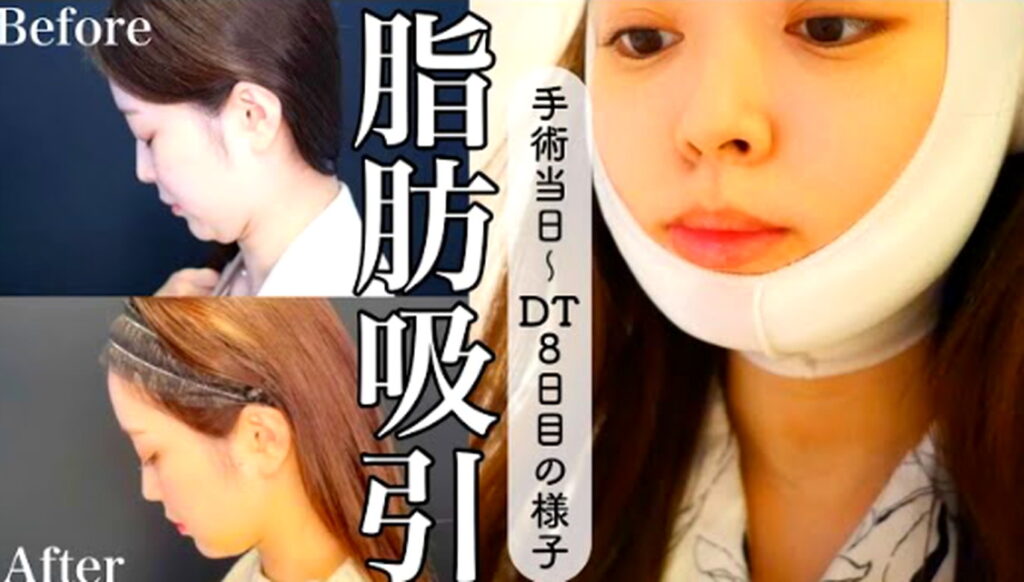 山本月 整形 脂肪吸引 出典：YouTubeより